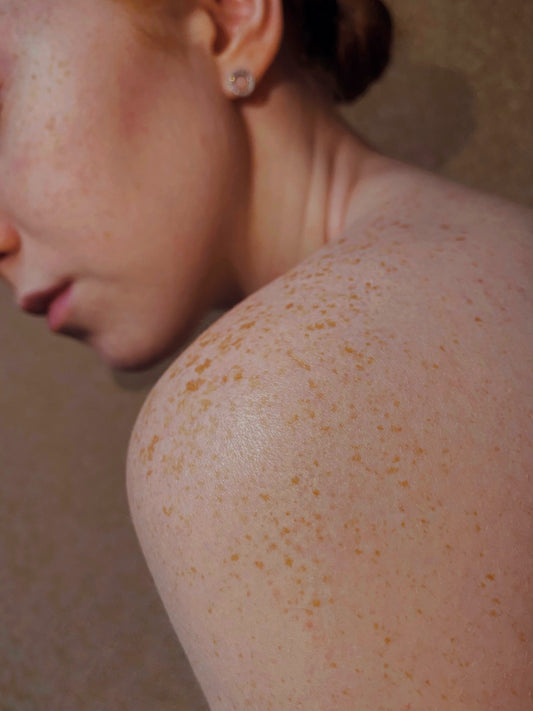 Hard Water Rash: Can Hard Water Cause Skin Irritation?